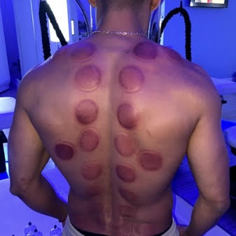 Functional Cupping